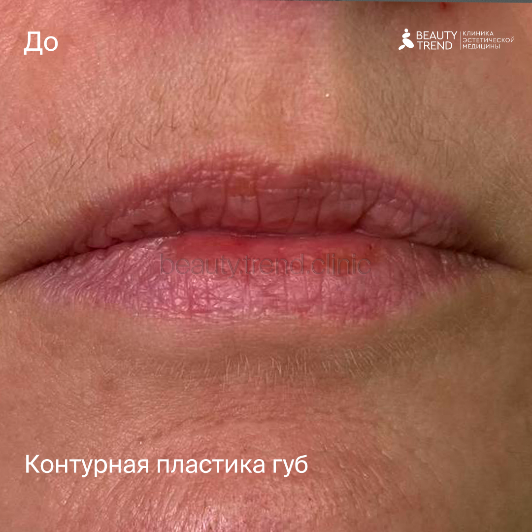 Контурная пластика губ - до 1